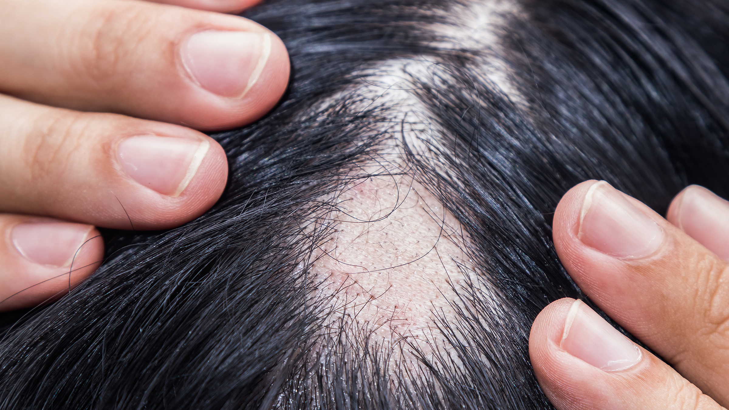 You are currently viewing Female Hair Loss: Here’s What You Should Know!